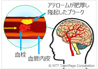 図6　アテローム血栓性脳梗塞
